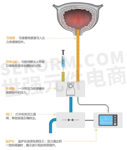 图1  导尿管应用示意图